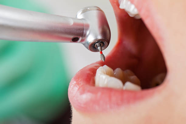 Best Emergency Wisdom Teeth Removal in Alma, AR